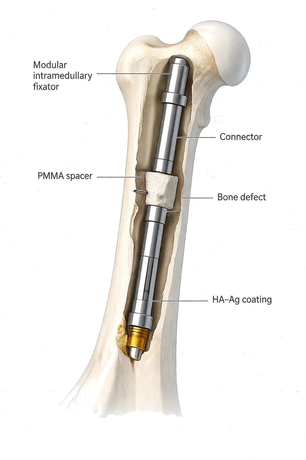 CITadel system — modular intramedullary fixator with annotations